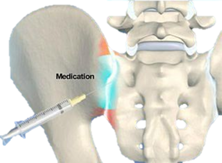 Sacroiliac Joint Pain - Rehab On The Road