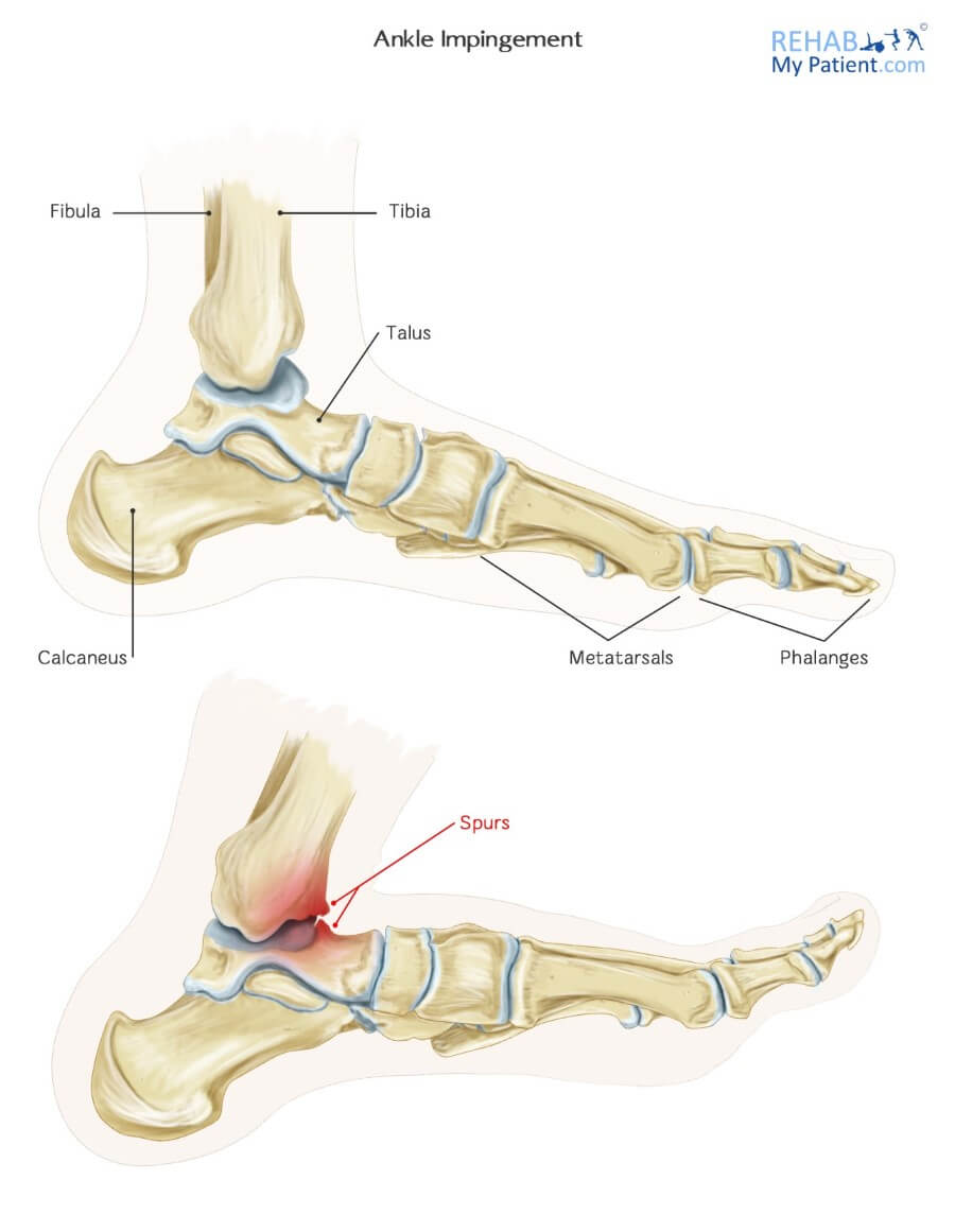 Anterior Ankle Impingement Syndrome