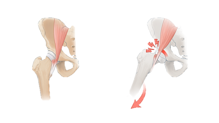 Snapping Hip Syndrome Rehab On The Road