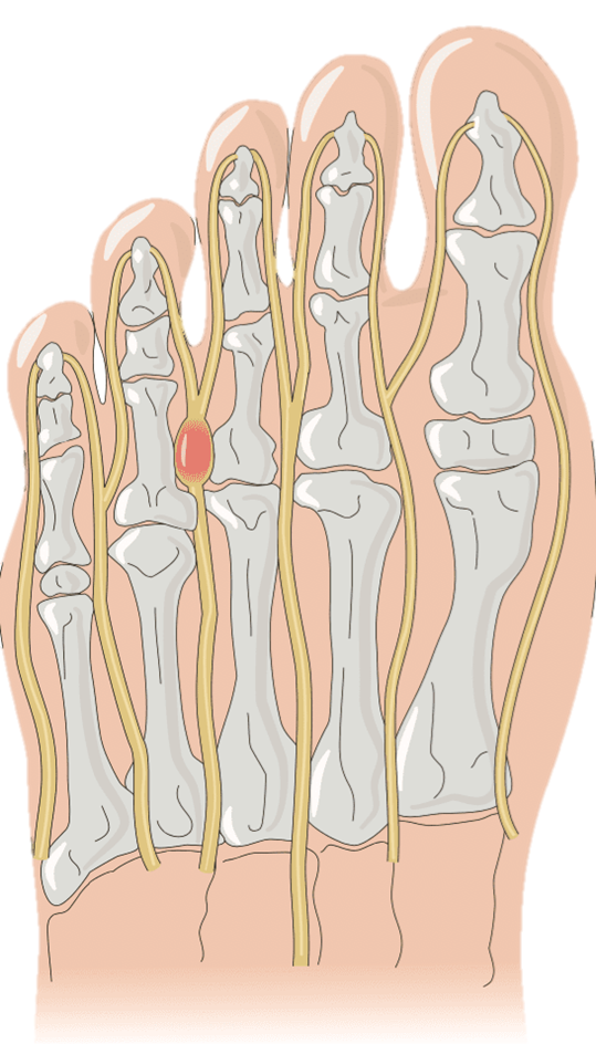 Morton Neuroma Rehab On The Road